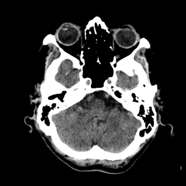 File:Brain metastases from lung cancer (Radiopaedia 27849-28092 Axial non-contrast 11).jpg