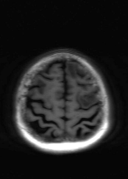File:Brain metastases from squamocellular lung cancer (Radiopaedia 56515-63222 Axial T1 21).jpg