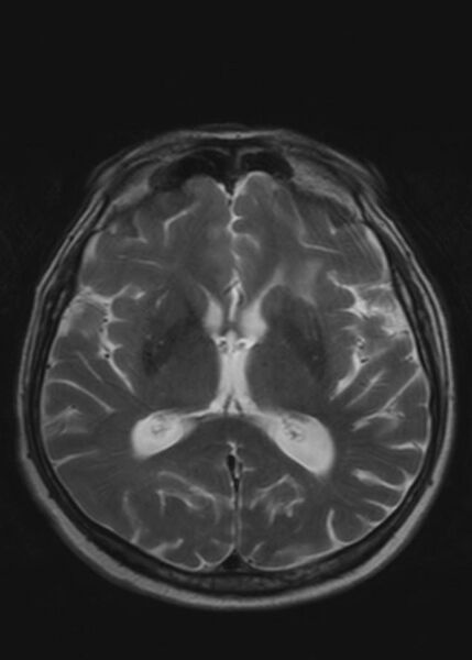 File:Brain metastases from squamocellular lung cancer (Radiopaedia 56515-63222 Axial T2 14).jpg