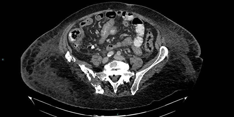 File:Breast cancer pelvic bony metastases (Radiopaedia 84470-99824 Axial bone window 23).jpg