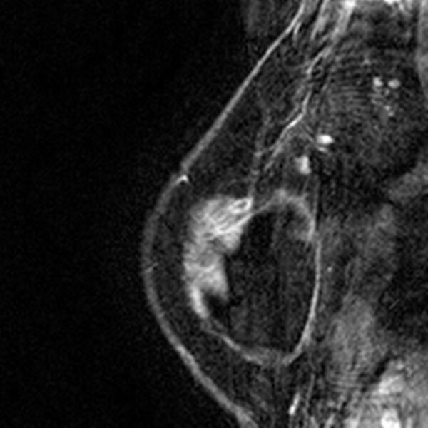 File:Breast implants - MRI (Radiopaedia 26864-27035 Sagittal T2 116).jpg