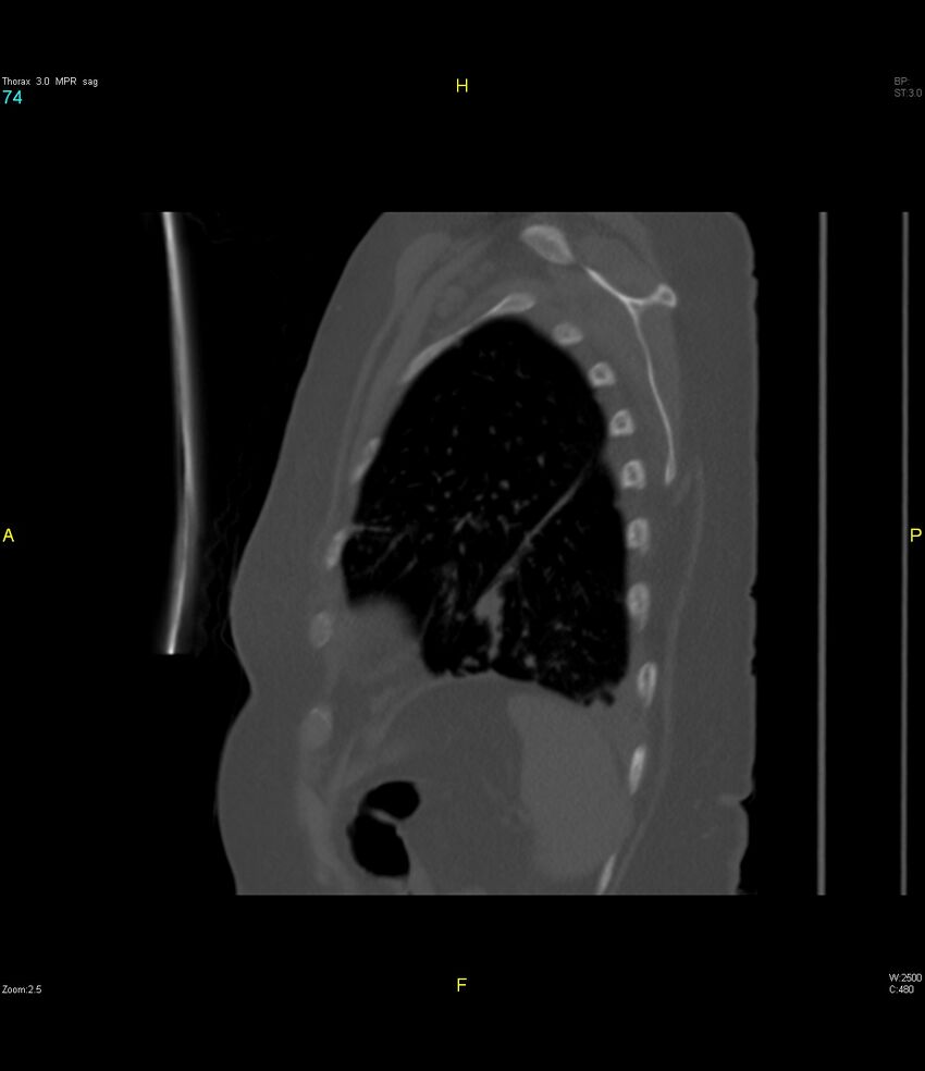 Breast primary with lung and bone metastases (Radiopaedia 40620-43228 Sagittal bone window 74).jpg