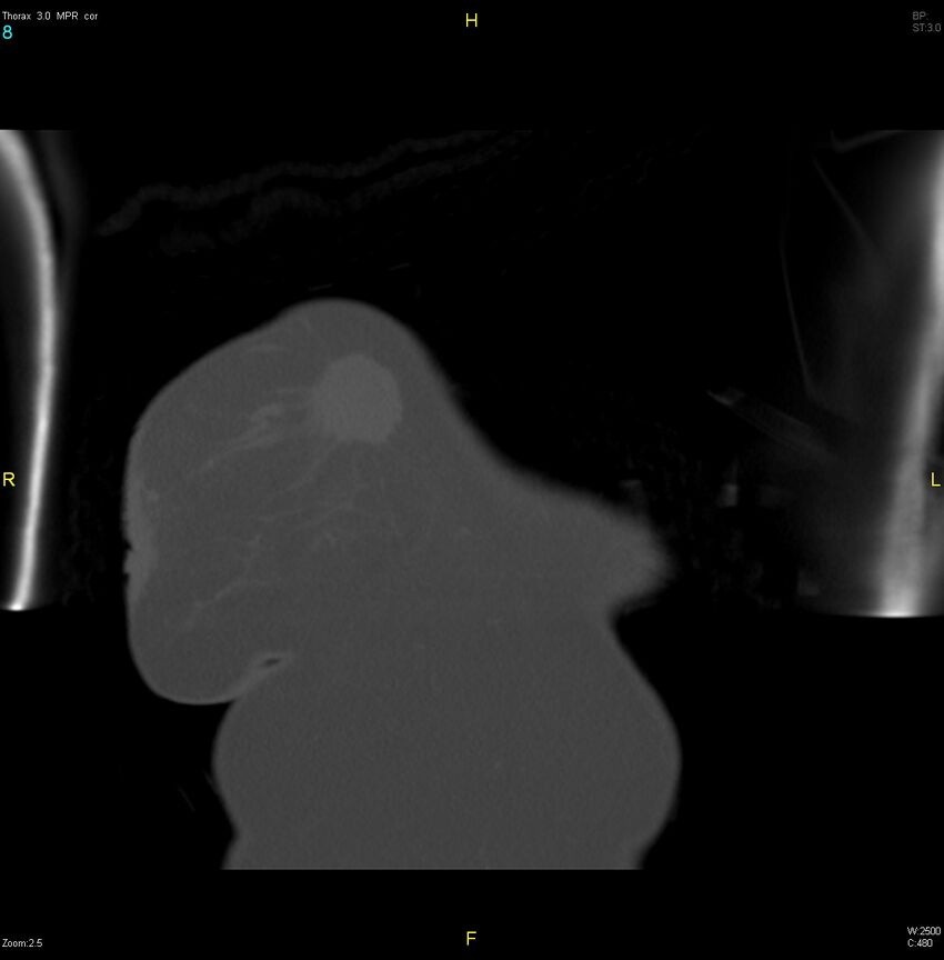 Breast primary with lung and bone metastases (Radiopaedia 40620-43228 bone window 8).jpg