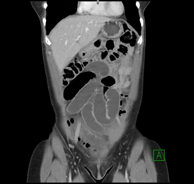 File:Broad ligament hernia (Radiopaedia 63260-71832 B 8).jpg