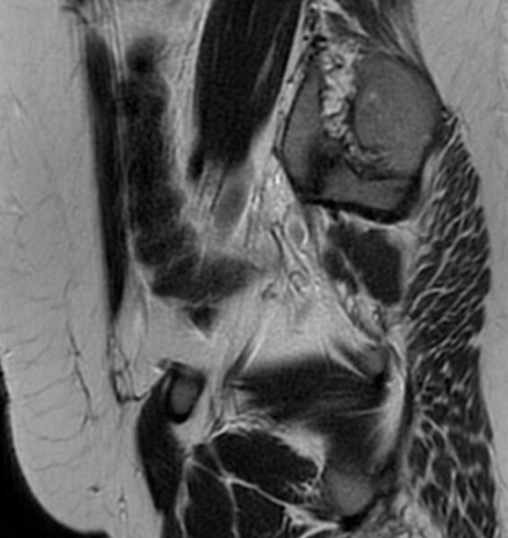 File:Broad ligament leiomyoma (Radiopaedia 81634-95516 Sagittal T2 24).jpg