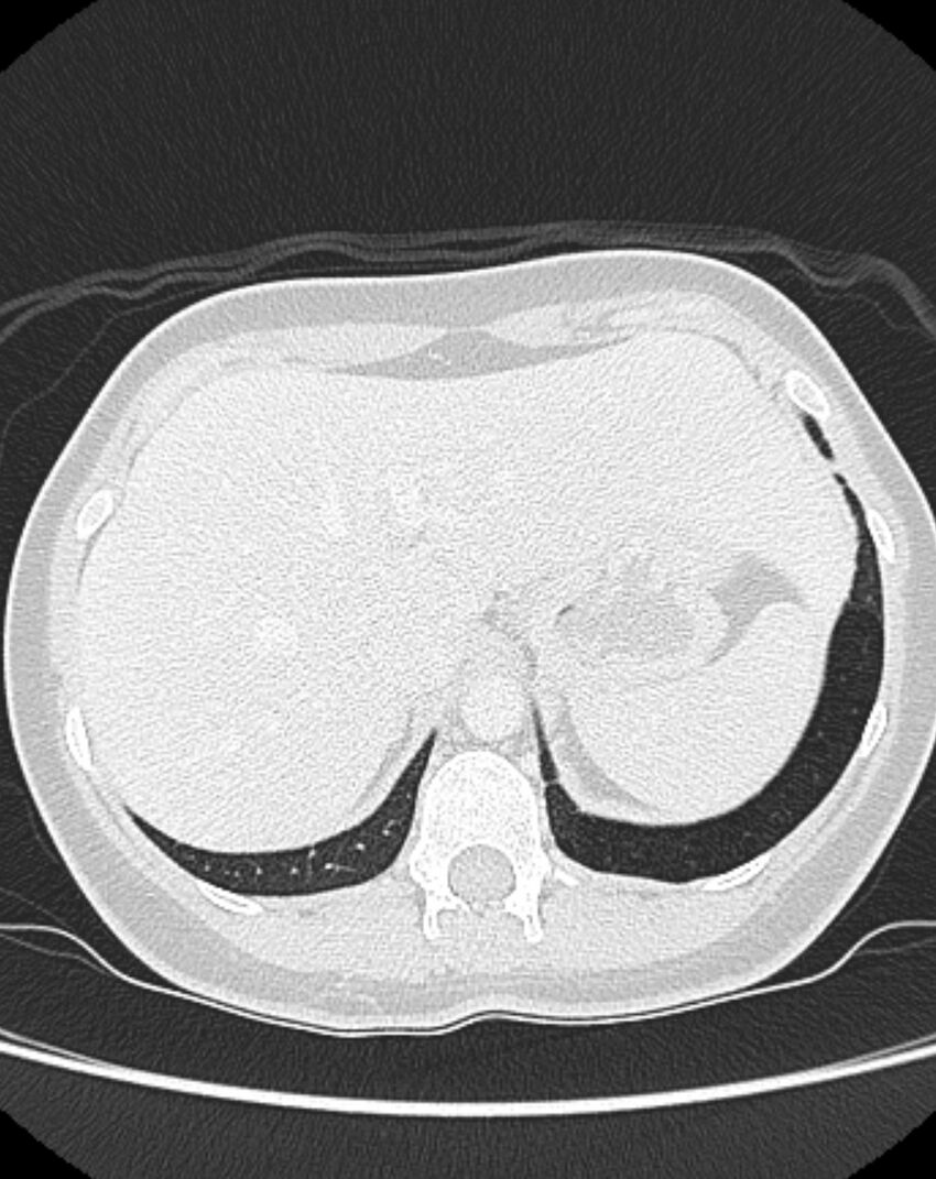 Bronchial atresia (Radiopaedia 50007-55297 Axial lung window 104).jpg