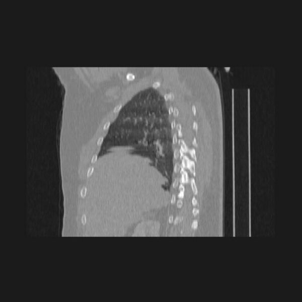 File:Bronchial atresia (Radiopaedia 60685-68439 Sagittal lung window 21).jpg