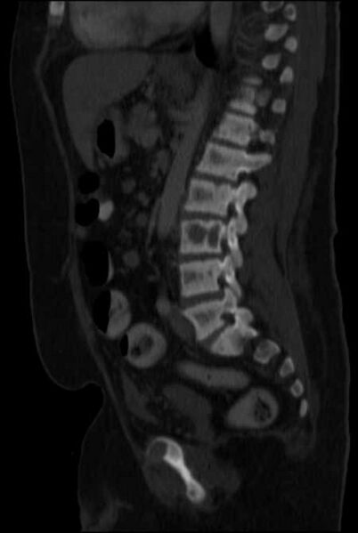 File:Brown tumors compressing the spinal cord (Radiopaedia 68442-77988 H 32).jpg