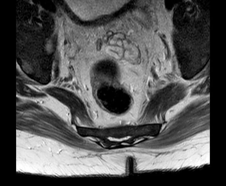 File:Brown tumors compressing the spinal cord (Radiopaedia 68442-78030 Axial T2 - lumbar 2).jpg