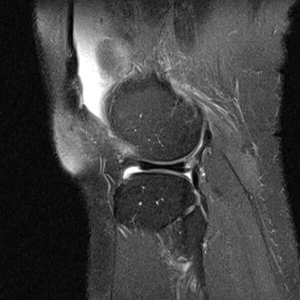 File:Bucket handle tear - medial meniscus (Radiopaedia 79028-91942 Sagittal PD fat sat 4).jpg