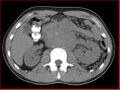 Burned-out testicular choriocarcinoma (Radiopaedia 32822-34040 Axial non-contrast 8).jpg