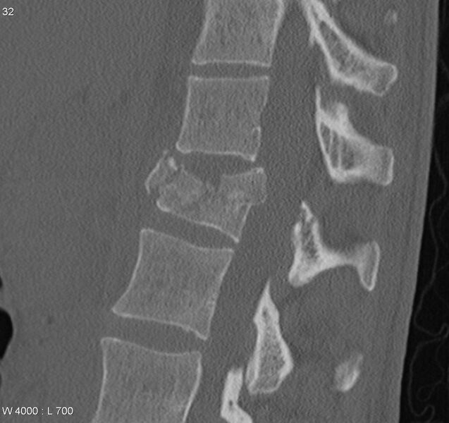 File:Burst fracture (Radiopaedia 5274-7018 Sagittal bone window 1).jpg