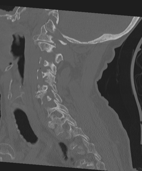 File:C2 fracture with vertebral artery dissection (Radiopaedia 37378-39199 Sagittal bone window 30).png