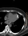 Calcified cardiac fibroma (Radiopaedia 39267-41519 Axial non-contrast 7).jpg