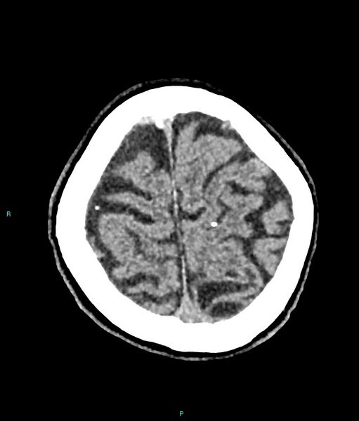 File:Calcified cerebral emboli from left ventricular thrombus (Radiopaedia 84420-99758 Axial non-contrast 17).jpg