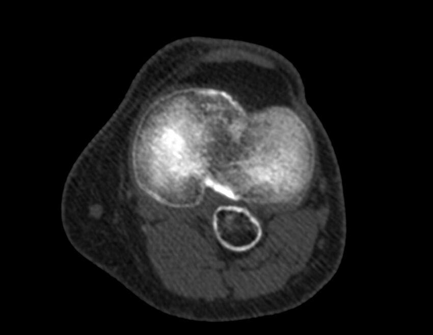 Calcified hematoma - popliteal fossa (Radiopaedia 63938-72763 Axial bone window 34).jpg