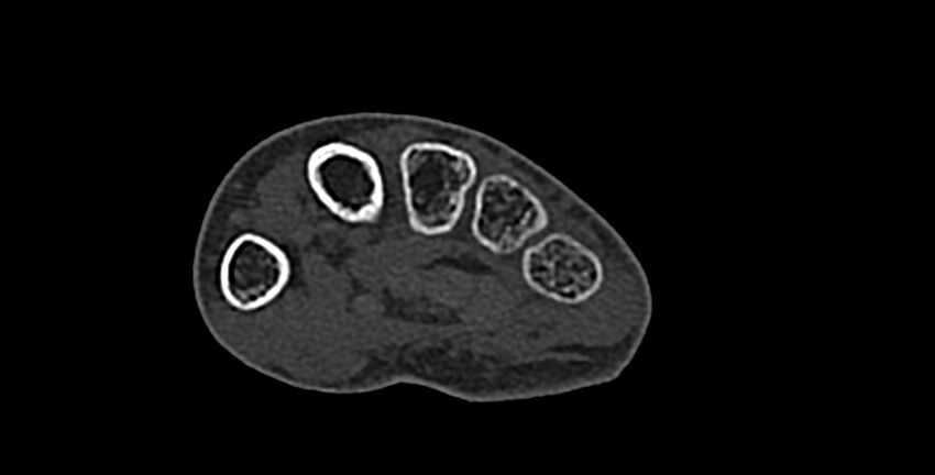 Calcifying aponeurotic fibroma (Radiopaedia 88423-105064 Axial bone window 136).jpg