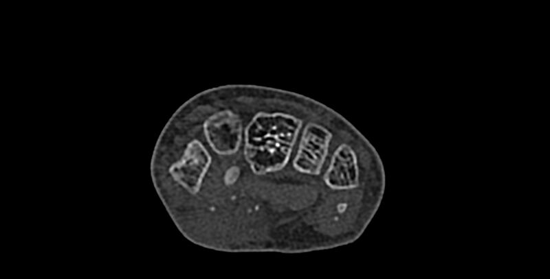 File:Calcifying aponeurotic fibroma (Radiopaedia 88423-105064 Axial bone window 83).jpg