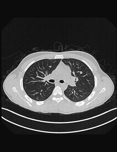 File:Calcifying pulmonary metastases (Radiopaedia 33359-34396 Axial lung window 25).jpg