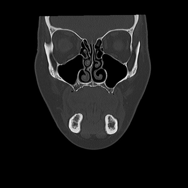 File:Canal up mastoidectomy (Radiopaedia 78108-90638 Coronal bone window 5).jpg