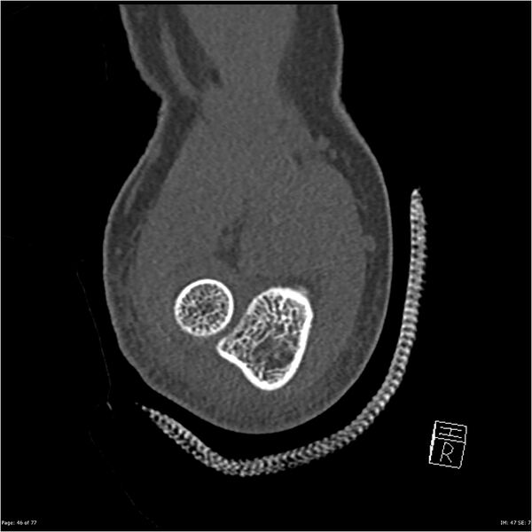 File:Capitellum fracture (Radiopaedia 23352-23426 Coronal bone window 46).jpg