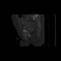 Carcinoma cervix- brachytherapy applicator (Radiopaedia 33135-34173 Sagittal bone window 123).jpg