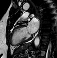 Cardiac sarcoidosis (Radiopaedia 74548-85535 2ch Cine SSFP 6).jpg