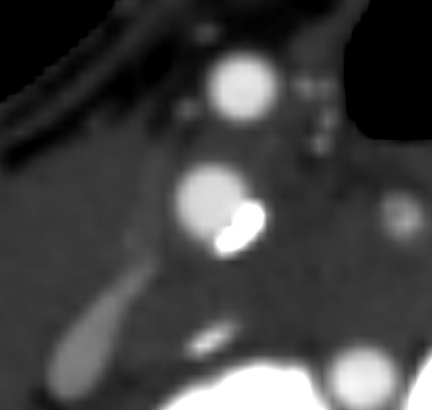 Carotid near-occlusion (Radiopaedia 85304-100887 M 55).jpg