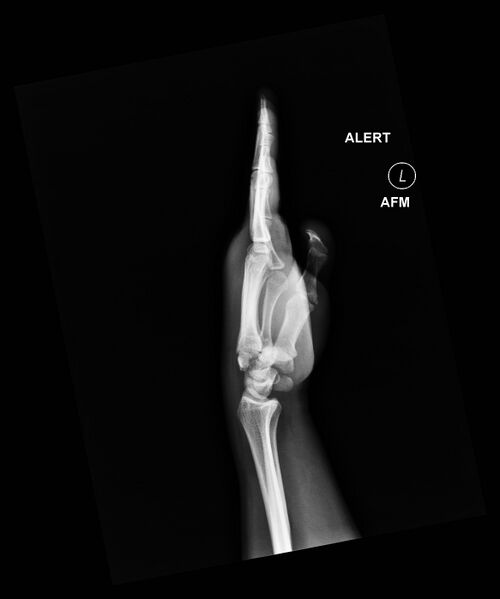File:Carpal fractures (smart watch impaction) (Radiopaedia 55844-62429 Lateral 1).jpg