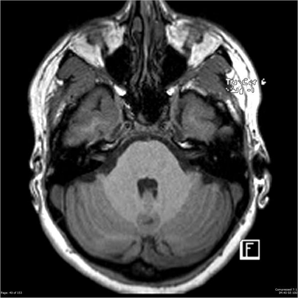 File:Cavernous malformation (cavernous angioma or cavernoma) (Radiopaedia 36675-38237 Axial T1 29).jpg