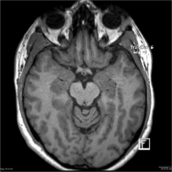 File:Cavernous malformation (cavernous angioma or cavernoma) (Radiopaedia 36675-38237 Axial T1 48).jpg