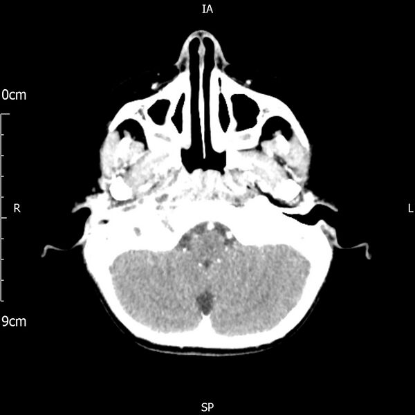 File:Cavernous sinus thrombosis (Radiopaedia 79414-92510 Axial Brain 56).jpg