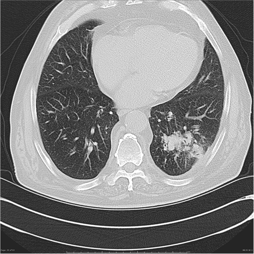 Cavitating left lower lobe lesion - squamous cell lung cancer (Radiopaedia 27749-28176 Axial lung window 35).jpg