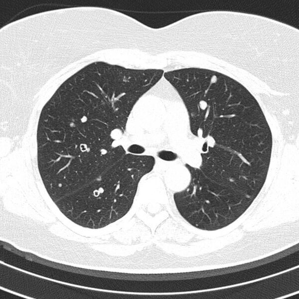 File:Cavitating pulmonary metastases (Radiopaedia 17796-17555 Axial lung window 7).jpg