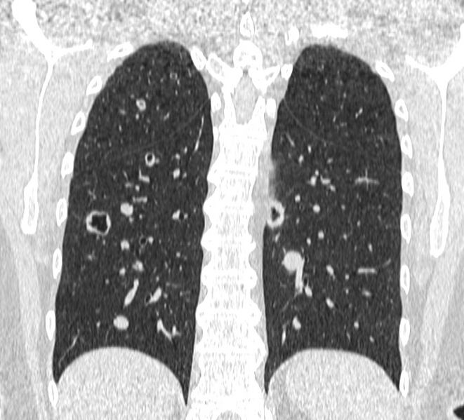 File:Cavitating pulmonary metastases (Radiopaedia 17796-17555 Coronal lung window 21).jpg
