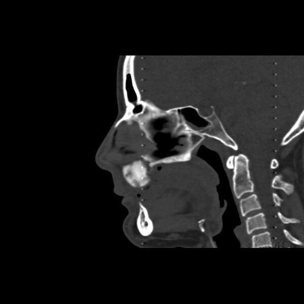 File:Cemento-ossifying fibroma (Radiopaedia 21243-21149 Sagittal bone window 7).jpg