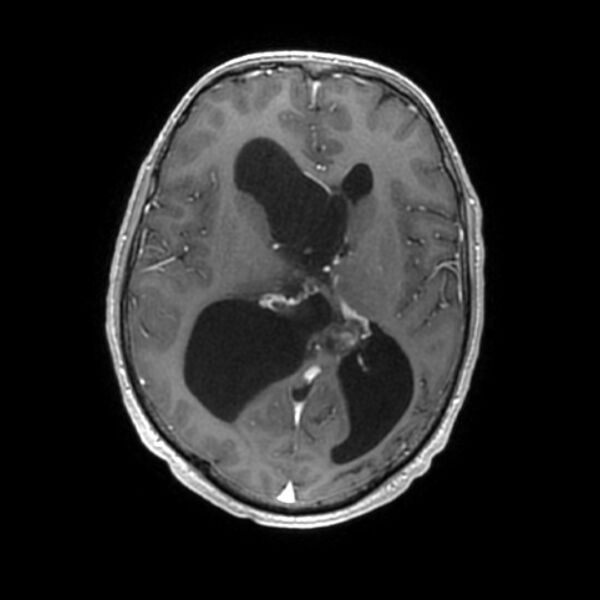 File:Central neurocytoma (Radiopaedia 67618-77021 Axial T1 C+ 15).jpg