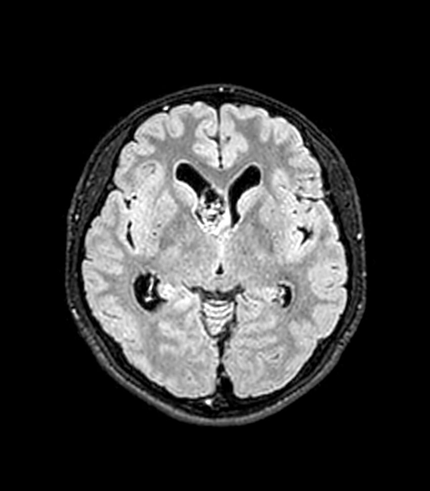 Central neurocytoma (Radiopaedia 79320-92380 Axial FLAIR 171).jpg