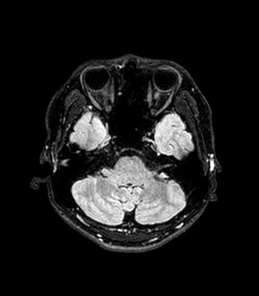 Central neurocytoma (Radiopaedia 79320-92380 Axial FLAIR 232).jpg