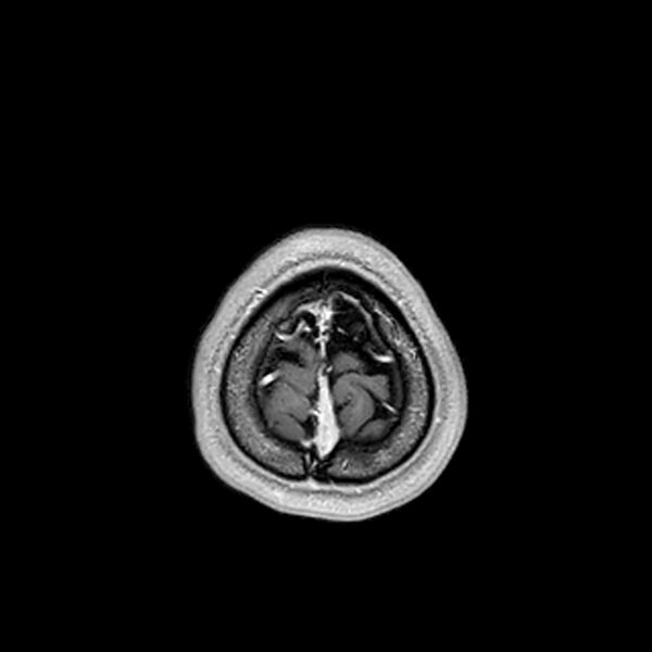 File:Central neurocytoma (Radiopaedia 79320-92380 Axial T1 C+ 217).jpg