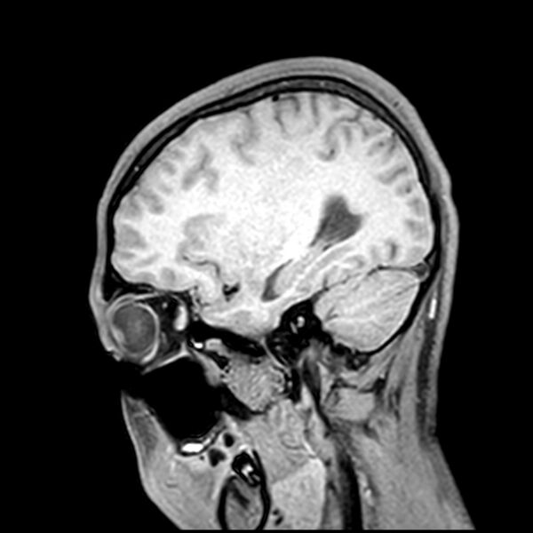 File:Central neurocytoma (Radiopaedia 79320-92380 Sagittal T1 78).jpg