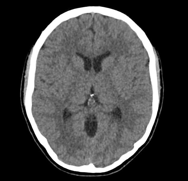File:Cerebellar agenesis (Radiopaedia 30203-30817 Axial non-contrast 23).jpg