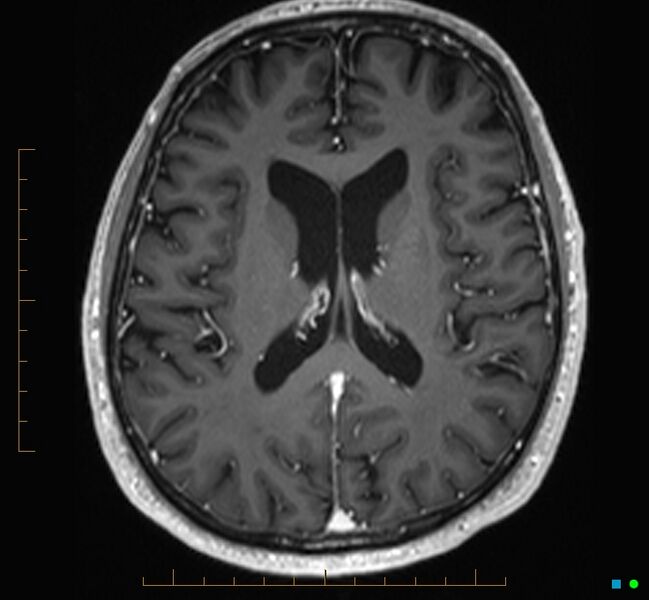 File:Cerebellar gangliocytoma (Radiopaedia 65377-74422 Axial T1 C+ 78).jpg