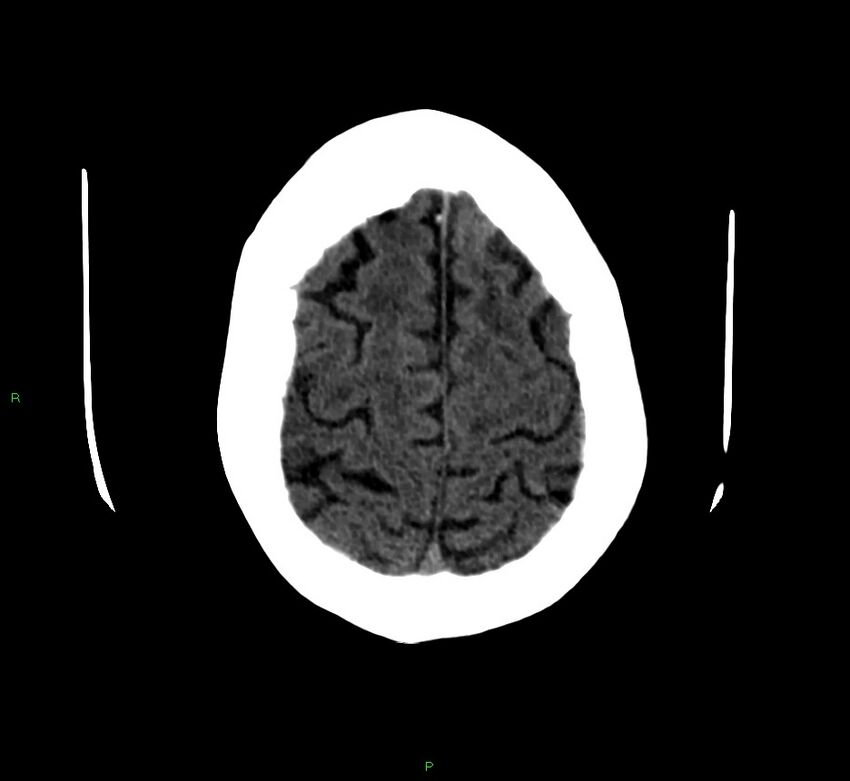 Cerebellar hemorrhage (Radiopaedia 58792-66026 Axial non-contrast 10).jpg