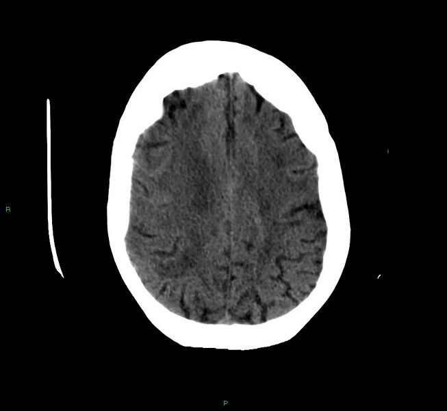 File:Cerebellar hemorrhage (Radiopaedia 58792-66026 Axial non-contrast 15).jpg