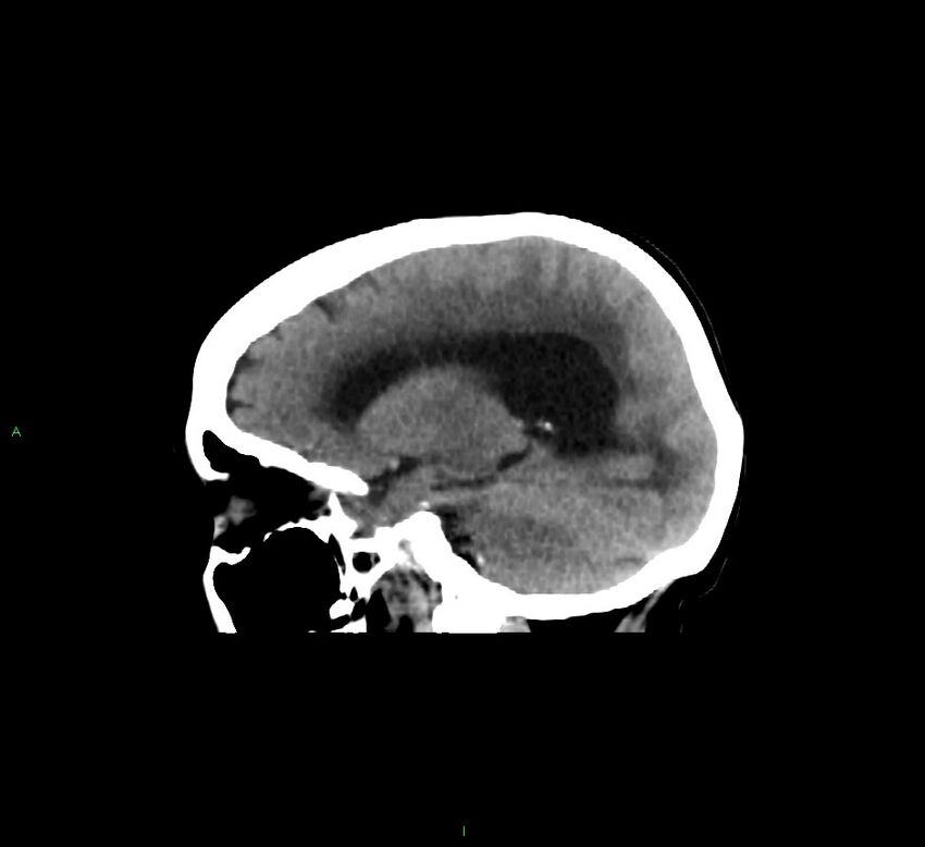 Cerebellar hemorrhage (Radiopaedia 58793-66027 C 33).jpg