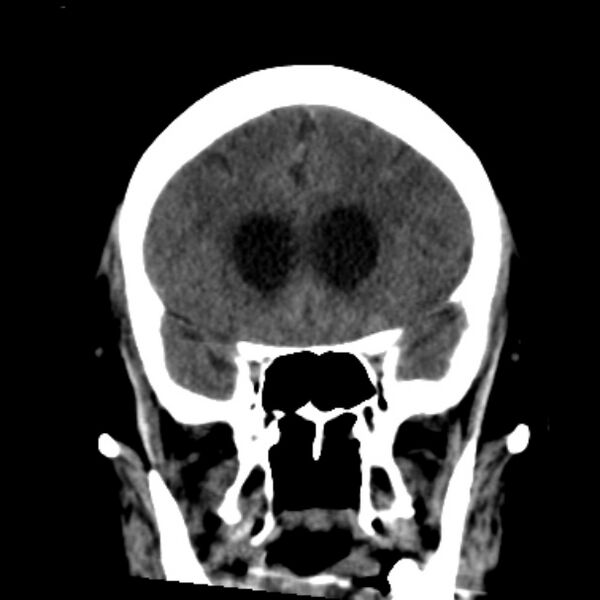 File:Cerebellar hemorrhage causing obstructive hydrocephalus (Radiopaedia 33989-35207 Coronal non-contrast 19).jpg
