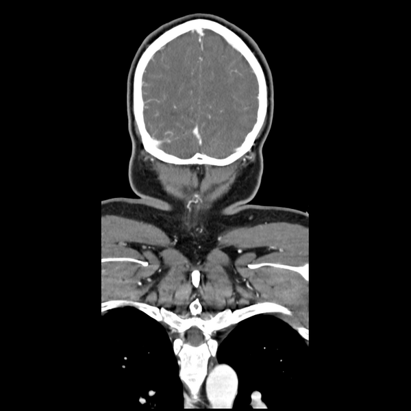File:Cerebellar infarct due to vertebral artery dissection with posterior fossa decompression (Radiopaedia 82779-97029 D 54).png