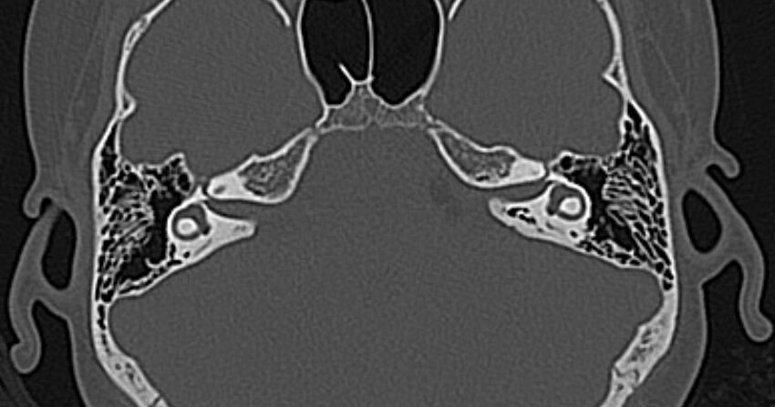 Cerebellopontine angle lipoma (Radiopaedia 57303-64242 Axial bone window 33).jpg