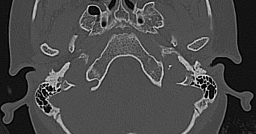 Cerebellopontine angle lipoma (Radiopaedia 57303-64242 Axial bone window 6).jpg
